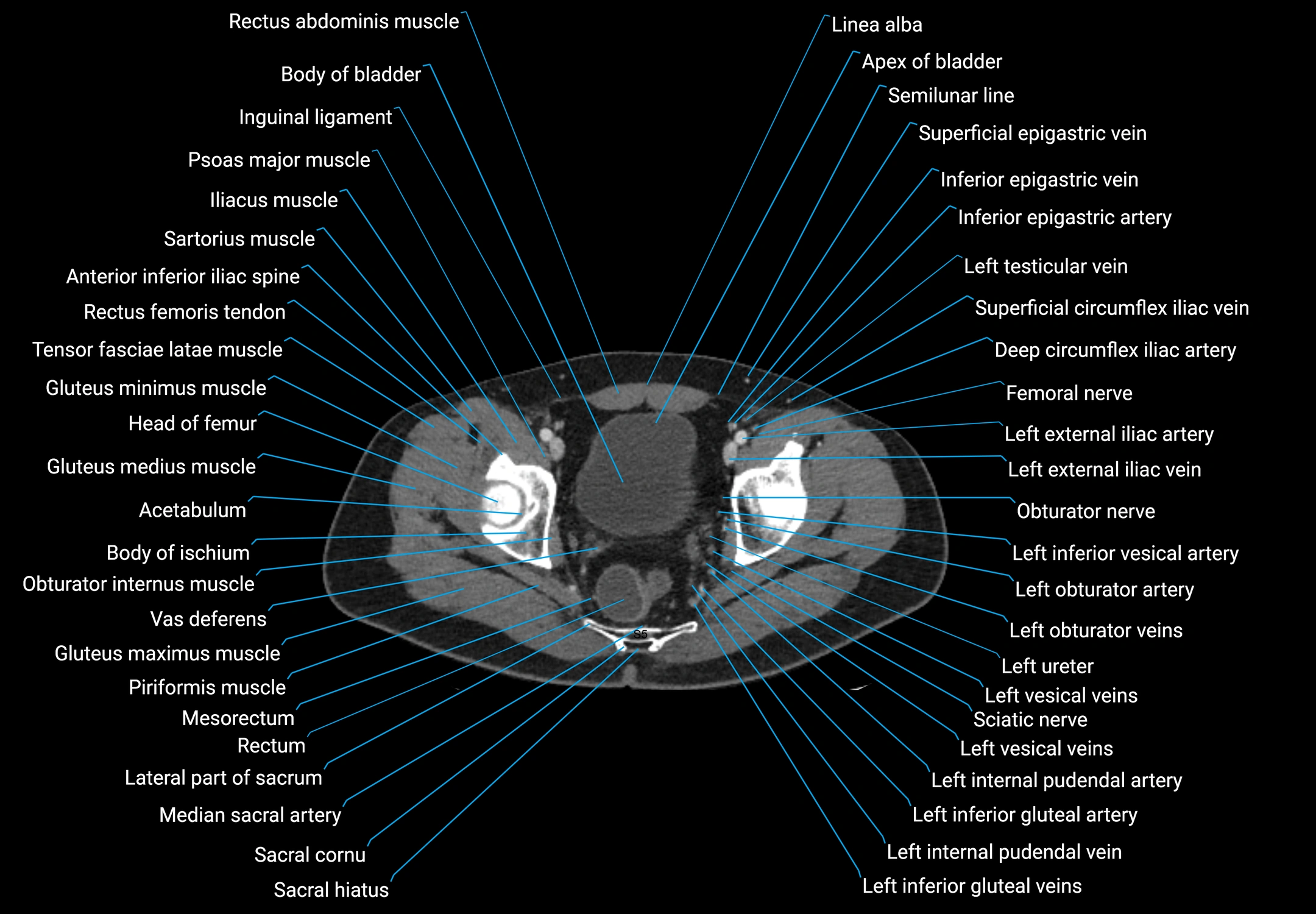 CT male pelvis axial cross sectional anatomy labelled radiology image -00178.webp